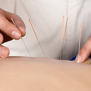 acupunctuur