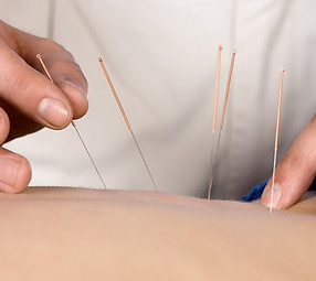 Acupuncture