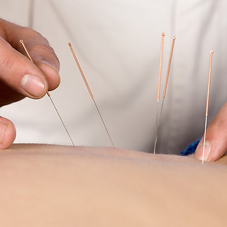 Acupuncture