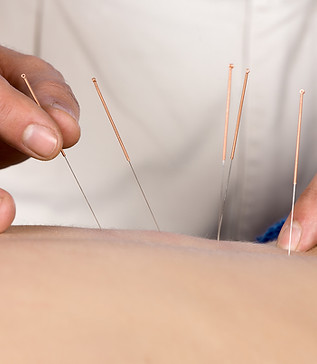 acupunctur needles - pregnancy