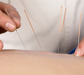 Acupuncture