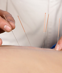 Séance d'acupuncture