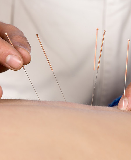 Acupuncture