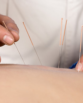 Acupuncture