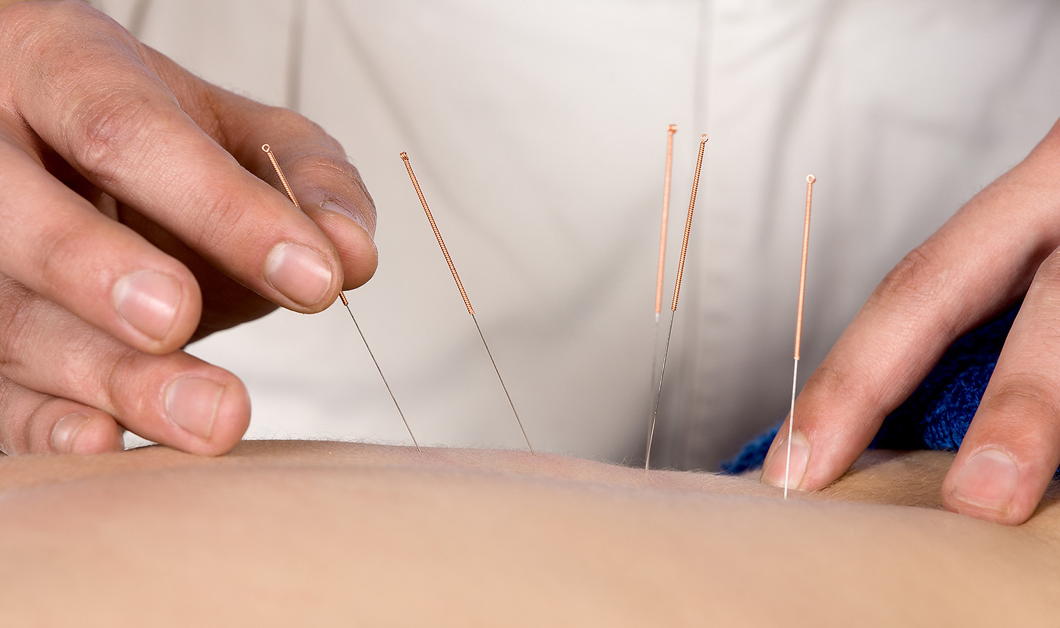 Acupuncture