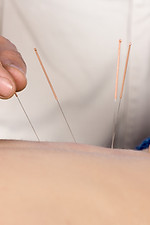 Acupuncture