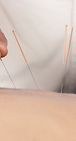 Acupuncture Therapy Session