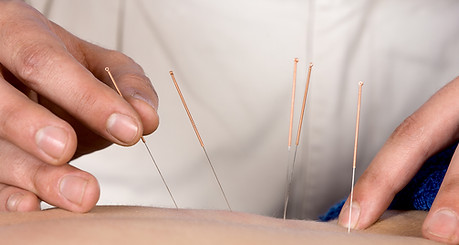 Acupuncture