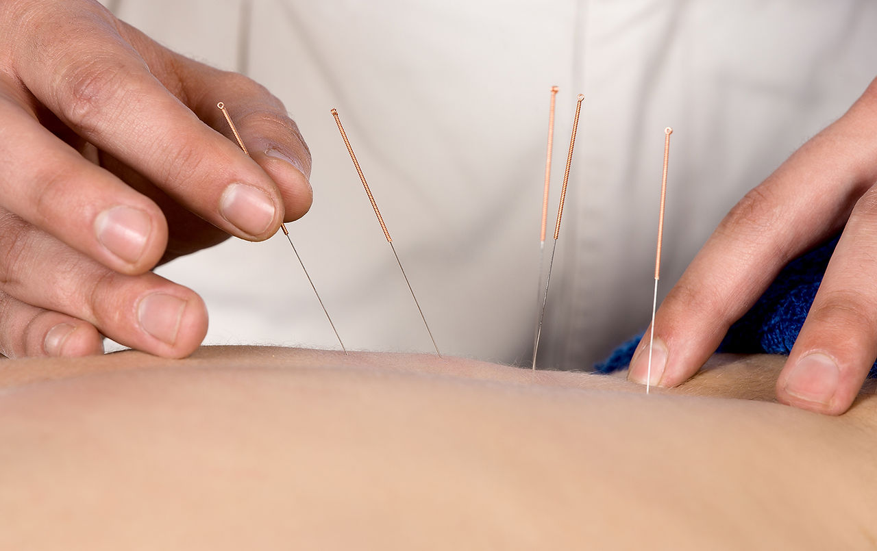 Acupuncture
