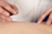 Acupuncture