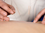 dry needling Preston