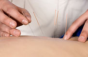 Acupuncture