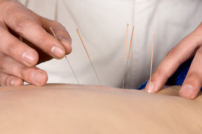 Acupuncture Needles