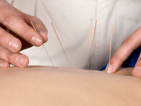 What does acupuncture actually feel like? 针灸的感觉如何?
