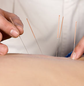 Acupuncture Therapy Session