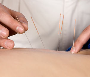 Acupuncture