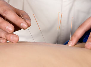 Acupuncture Therapy Session