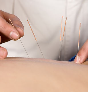 Acupuncture