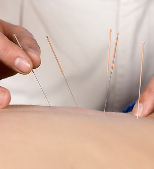 Acupuncture Therapy Session