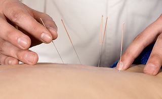 Acupuncture