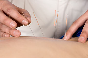 Acupuncture Therapy Session