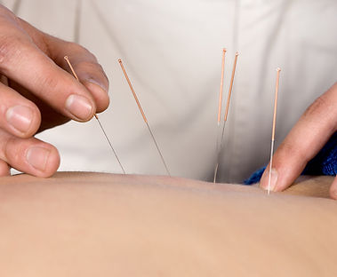 Acupuncture Therapy Session