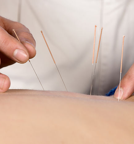 Acupuncture StoonRMT