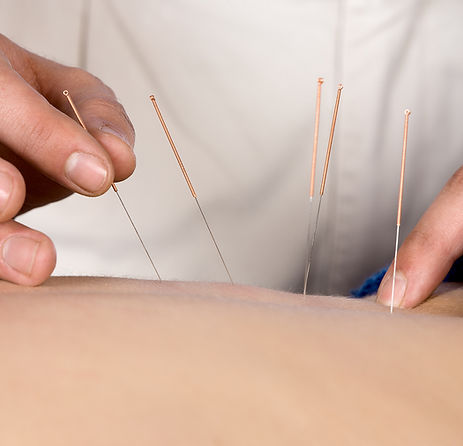 Acupuncture being performed to a patient.