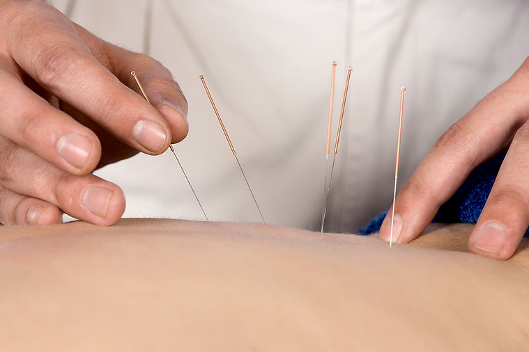 Acupuncture