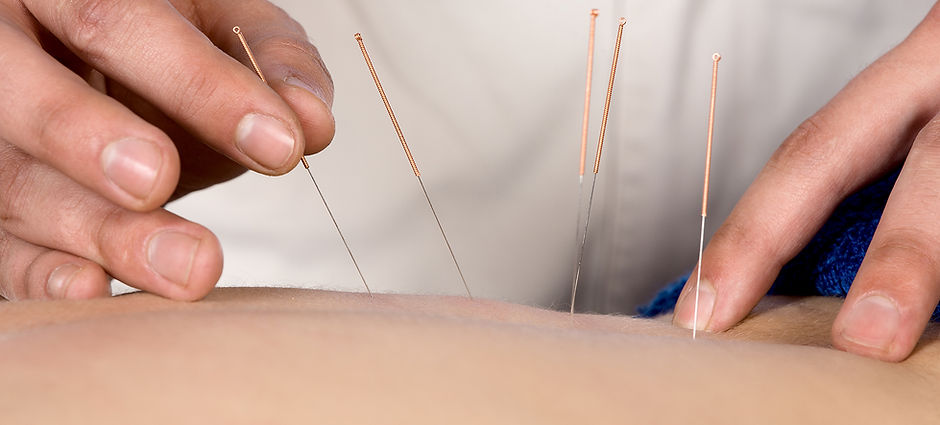 Acupuncture