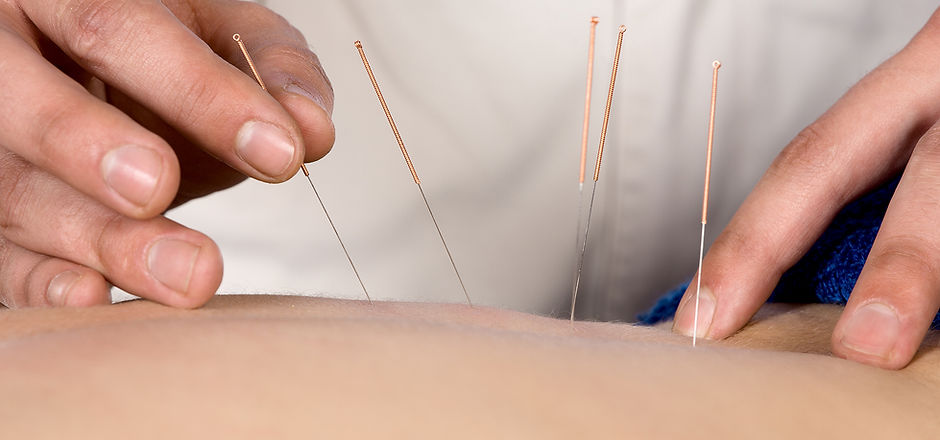 Acupuncture