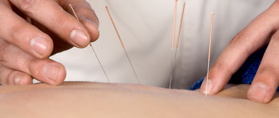 Acupuncture