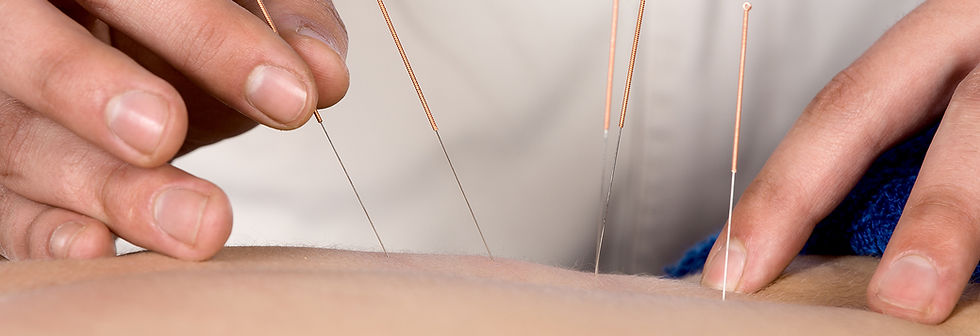 Acupuncture