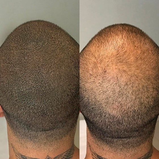 scalp micropigmentation SMP maple ridge ink bunker