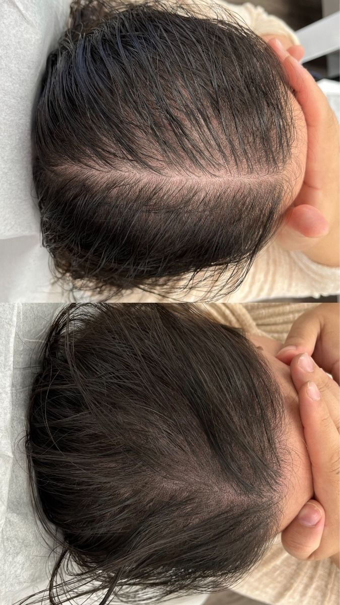 scalp micropigmentation SMP maple ridge ink bunker