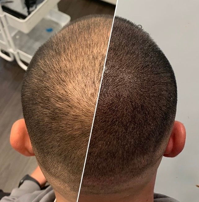 scalp micropigmentation SMP maple ridge ink bunker