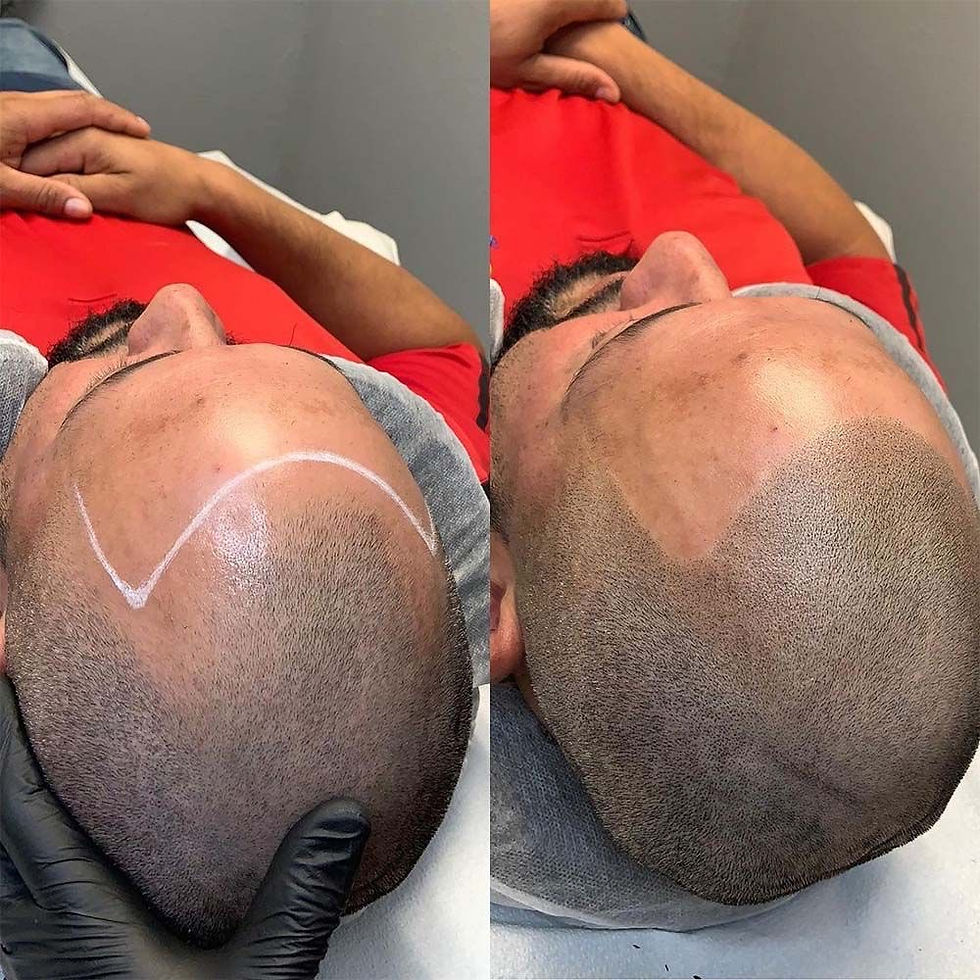 scalp micropigmentation SMP maple ridge ink bunker Raha
