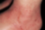 مچ پای فردی با پوست سفید. پوست اطراف مچ پا صورتی است و دارای لکه های قرمز کوچک است.