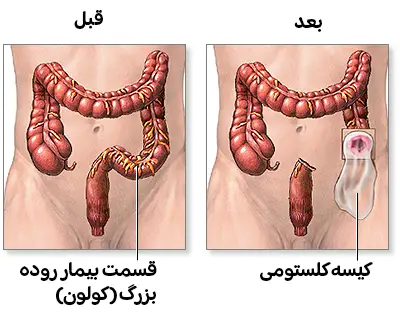 دو نمای مقایسه‌ای از روده: نمای 'قبل' که قسمت بیمار روده بزرگ را نشان می‌دهد، و نمای 'بعد' (کلستومی) که نشان می‌دهد قسمت بیمار برداشته شده و یک کیسه کلستومی به دهانه روده در شکم متصل شده است.