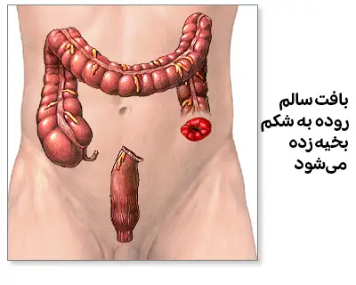 مرحله‌ای از کلستومی که نشان می‌دهد بافت سالم روده از دی واره شکم به بیرون کشیده و به شکم بخیه زده می‌شود.