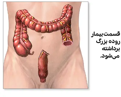 مرحله‌ای از جراحی کولوستومی که نشان می‌دهد قسمت بیمار روده بزرگ برداشته شده و بافت روده در حال قطع شدن است