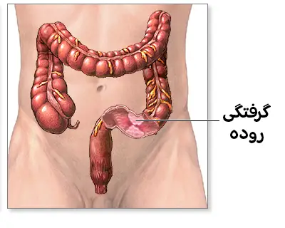  روده بزرگ انسان که انسداد یا گرفتگی روده (با برچسب گرفتگی روده) را در قسمت پایین نشان داده شده.