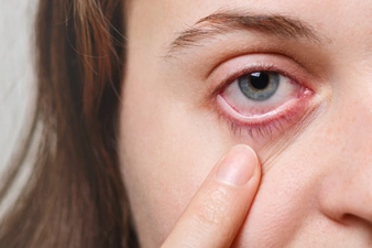 What Is Pink Eye?
