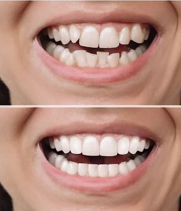 Dental bonding