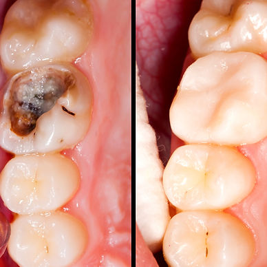 Tooth-colored filling