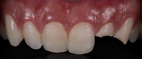 Broken teeth