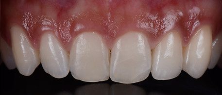 Broken teeth emergency