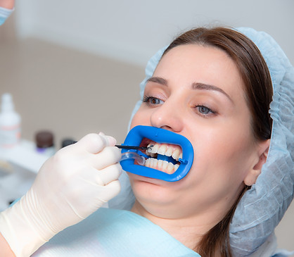 Teeth whitening Lynnwood
