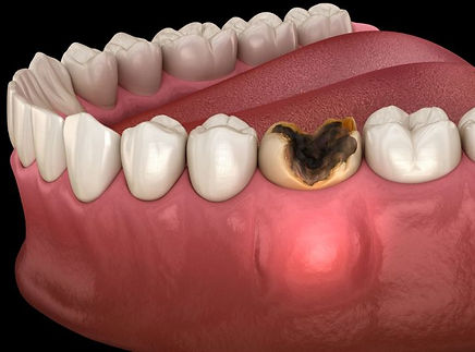 Tooth infection