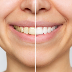 Teeth Whitening near me
